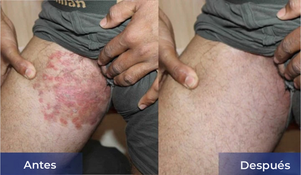 Crema Calmante para Verrugas